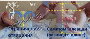 Клинические симптомы при врожденном вывихе бедра