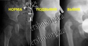Рентгенографія тазу в нормі, при наявності підвивиху і вивиху стегна
