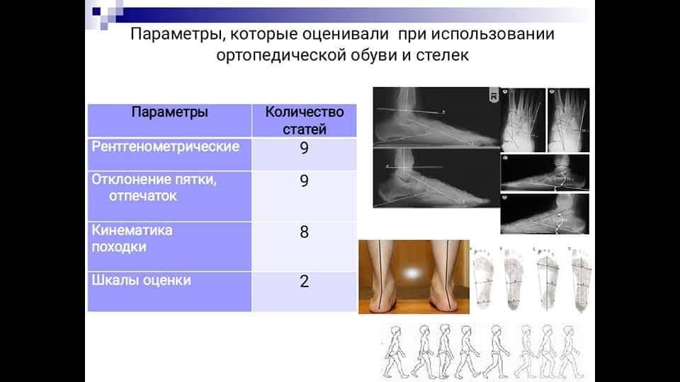 Ortopedicheskaya-obuv-i-stelki-neeffektivnyi-dlya-lecheniya-mobilnogo-ploskostopiya-u-detey-3