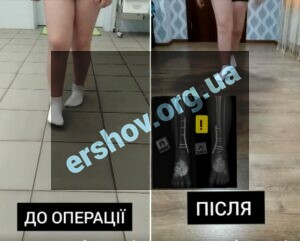 лікування інтоінга